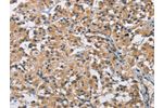 The image on the left is immunohistochemistry of paraffin-embedded Human thyroid cancer tissue using CSB-PA192471(BMP15 Antibody) at dilution 1/40, on the right is treated with fusion protein. (Original magnification: 