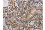 The image on the left is immunohistochemistry of paraffin-embedded Human thyroid cancer tissue using CSB-PA192473(BTG1 Antibody) at dilution 1/15, on the right is treated with fusion protein. (Original magnification: 