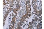 The image on the left is immunohistochemistry of paraffin-embedded Human esophagus cancer tissue using CSB-PA192641(BMP3 Antibody) at dilution 1/30, on the right is treated with synthetic peptide. (Original magnification: 
