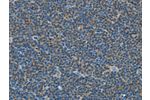 The image on the left is immunohistochemistry of paraffin-embedded Human lymphoma tissue using CSB-PA192719(COX7B2 Antibody) at dilution 1/15, on the right is treated with fusion protein. (Original magnification: 