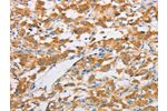 The image on the left is immunohistochemistry of paraffin-embedded Human thyroid cancer tissue using CSB-PA193095(FARSB Antibody) at dilution 1/20, on the right is treated with fusion protein. (Original magnification: 