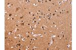 The image on the left is immunohistochemistry of paraffin-embedded Human brain tissue using CSB-PA193371(CSNK1D Antibody) at dilution 1/50, on the right is treated with fusion protein. (Original magnification: 