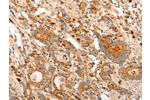 The image on the left is immunohistochemistry of paraffin-embedded Human gastic cancer tissue using CSB-PA193428(CDKN1C Antibody) at dilution 1/15, on the right is treated with synthetic peptide. (Original magnification: 