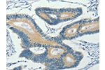 The image on the left is immunohistochemistry of paraffin-embedded Human colon cancer tissue using CSB-PA193476(ASB8 Antibody) at dilution 1/30, on the right is treated with fusion protein. (Original magnification: 