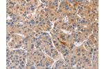 The image on the left is immunohistochemistry of paraffin-embedded Human liver cancer tissue using CSB-PA193639(CCL4 Antibody) at dilution 1/40, on the right is treated with fusion protein. (Original magnification: 