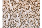 The image on the left is immunohistochemistry of paraffin-embedded Human liver cancer tissue using CSB-PA193640(LMNA Antibody) at dilution 1/60, on the right is treated with fusion protein. (Original magnification: 