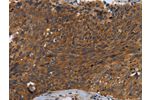 The image on the left is immunohistochemistry of paraffin-embedded Human cervical cancer tissue using CSB-PA193987(CSF2RA Antibody) at dilution 1/35, on the right is treated with synthetic peptide. (Original magnification: 