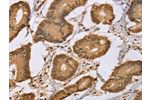 The image on the left is immunohistochemistry of paraffin-embedded Human colon cancer tissue using CSB-PA194515(CEL Antibody) at dilution 1/50, on the right is treated with synthetic peptide. (Original magnification: 