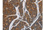 The image on the left is immunohistochemistry of paraffin-embedded Human breast cancer tissue using CSB-PA194613(APEH  Antibody) at dilution 1/30, on the right is treated with synthetic peptide. (Original magnification: 