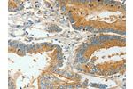 The image on the left is immunohistochemistry of paraffin-embedded Human colon cancer tissue using CSB-PA194965(BAAT Antibody) at dilution 1/30, on the right is treated with fusion protein. (Original magnification: 