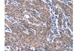 The image on the left is immunohistochemistry of paraffin-embedded Human gastic cancer tissue using CSB-PA195094(ESPL1 Antibody) at dilution 1/40, on the right is treated with synthetic peptide. (Original magnification: 