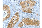 The image on the left is immunohistochemistry of paraffin-embedded Human cervical cancer tissue using CSB-PA195186(ANXA3 Antibody) at dilution 1/35, on the right is treated with fusion protein. (Original magnification: 