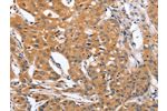 The image on the left is immunohistochemistry of paraffin-embedded Human lung cancer tissue using CSB-PA195809(BLNK Antibody) at dilution 1/50, on the right is treated with synthetic peptide. (Original magnification: 