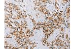 The image on the left is immunohistochemistry of paraffin-embedded Human prostate cancer tissue using CSB-PA195861(ATG4C Antibody) at dilution 1/25, on the right is treated with fusion protein. (Original magnification: 