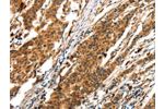 The image on the left is immunohistochemistry of paraffin-embedded Human gastric cancer tissue using CSB-PA196094(BCLAF1 Antibody) at dilution 1/25, on the right is treated with synthetic peptide. (Original magnification: 