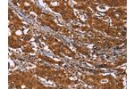 The image on the left is immunohistochemistry of paraffin-embedded Human gastic cancer tissue using CSB-PA196180(DCBLD2 Antibody) at dilution 1/50, on the right is treated with fusion protein. (Original magnification: 