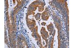 The image on the left is immunohistochemistry of paraffin-embedded Human gastic cancer tissue using CSB-PA196351(ACP6 Antibody) at dilution 1/50, on the right is treated with fusion protein. (Original magnification: 