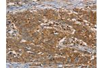 The image is immunohistochemistry of paraffin-embedded Human gastic cancer tissue using CSB-PA196408(CFL1 Antibody) at dilution 1/30. (Original magnification: 200)