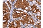 The image on the left is immunohistochemistry of paraffin-embedded Human gastic cancer tissue using CSB-PA196525(BCR Antibody) at dilution 1/15, on the right is treated with synthetic peptide. (Original magnification: 
