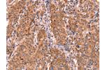 The image on the left is immunohistochemistry of paraffin-embedded Human gastic cancer tissue using CSB-PA196653(ABI1 Antibody) at dilution 1/40, on the right is treated with synthetic peptide. (Original magnification: 