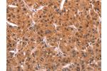The image on the left is immunohistochemistry of paraffin-embedded Human liver cancer tissue using CSB-PA196695(EMP2 Antibody) at dilution 1/20, on the right is treated with synthetic peptide. (Original magnification: 