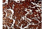 The image is immunohistochemistry of paraffin-embedded Human lung cancer tissue using CSB-PA196764(ANXA7 Antibody) at dilution 1/40. (Original magnification: 