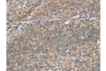 The image on the left is immunohistochemistry of paraffin-embedded Human cervical cancer tissue using CSB-PA196852(CST2 Antibody) at dilution 1/50, on the right is treated with fusion protein. (Original magnification: 