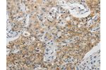 The image on the left is immunohistochemistry of paraffin-embedded Human lung cancer tissue using CSB-PA196946(CDH3 Antibody) at dilution 1/5, on the right is treated with fusion protein. (Original magnification: 