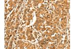 The image on the left is immunohistochemistry of paraffin-embedded Human breast cancer tissue using CSB-PA196950(DIRAS1 Antibody) at dilution 1/52, on the right is treated with synthetic peptide. (Original magnification: 