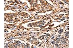 The image on the left is immunohistochemistry of paraffin-embedded Human breast cancer tissue using CSB-PA197126(ANXA6 Antibody) at dilution 1/17, on the right is treated with fusion protein. (Original magnification: 
