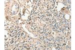 The image on the left is immunohistochemistry of paraffin-embedded Human gastric cancer tissue using CSB-PA197217(AGBL2 Antibody) at dilution 1/25, on the right is treated with fusion protein. (Original magnification: 