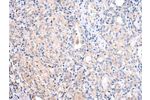 The image on the left is immunohistochemistry of paraffin-embedded Human thyroid cancer tissue using CSB-PA197802(ATF6 Antibody) at dilution 1/25, on the right is treated with synthetic peptide. (Original magnification: 