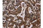 The image on the left is immunohistochemistry of paraffin-embedded Human liver cancer tissue using CSB-PA197834(FIS1 Antibody) at dilution 1/20, on the right is treated with fusion protein. (Original magnification: 