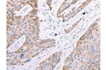 The image on the left is immunohistochemistry of paraffin-embedded Human esophagus cancer tissue using CSB-PA198099(GFRA3 Antibody) at dilution 1/60, on the right is treated with synthetic peptide. (Original magnification: 