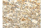 The image on the left is immunohistochemistry of paraffin-embedded Human liver cancer tissue using CSB-PA198192(BRWD1 Antibody) at dilution 1/20, on the right is treated with synthetic peptide. (Original magnification: 