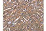 The image on the left is immunohistochemistry of paraffin-embedded Human thyroid cancer tissue using CSB-PA198566(CDCA4 Antibody) at dilution 1/50, on the right is treated with synthetic peptide. (Original magnification: 