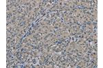The image on the left is immunohistochemistry of paraffin-embedded Human thyroid cancer tissue using CSB-PA198612(EDN1 Antibody) at dilution 1/30, on the right is treated with fusion protein. (Original magnification: 