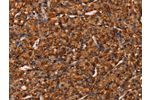 The image on the left is immunohistochemistry of paraffin-embedded Human prostate cancer tissue using CSB-PA199023(COL18A1 Antibody) at dilution 1/40, on the right is treated with synthetic peptide. (Original magnification: 