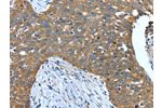The image on the left is immunohistochemistry of paraffin-embedded Human cervical cancer tissue using CSB-PA199144(DTX1 Antibody) at dilution 1/40, on the right is treated with synthetic peptide. (Original magnification: 