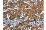 The image on the left is immunohistochemistry of paraffin-embedded Human gastic cancer tissue using CSB-PA199459(APOL1 Antibody) at dilution 1/40, on the right is treated with synthetic peptide. (Original magnification: 
