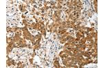 The image on the left is immunohistochemistry of paraffin-embedded Human esophagus cancer tissue using CSB-PA200381(BNIP1 Antibody) at dilution 1/30, on the right is treated with fusion protein. (Original magnification: 