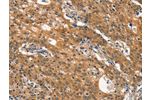 The image on the left is immunohistochemistry of paraffin-embedded Human gastic cancer tissue using CSB-PA200531(DNM2 Antibody) at dilution 1/40, on the right is treated with synthetic peptide. (Original magnification: 