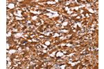 The image on the left is immunohistochemistry of paraffin-embedded Human thyroid cancer tissue using CSB-PA200670(BRK1 Antibody) at dilution 1/40, on the right is treated with synthetic peptide. (Original magnification: 