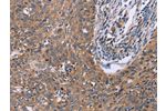 The image on the left is immunohistochemistry of paraffin-embedded Human cervical cancer tissue using CSB-PA200894(CSF2RB Antibody) at dilution 1/40, on the right is treated with synthetic peptide. (Original magnification: 