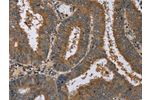 The image on the left is immunohistochemistry of paraffin-embedded Human colon cancer tissue using CSB-PA201270(DNAJA1 Antibody) at dilution 1/60, on the right is treated with fusion protein. (Original magnification: 