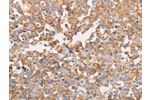 The image on the left is immunohistochemistry of paraffin-embedded Human breast cancer tissue using CSB-PA201320(GNA11 Antibody) at dilution 1/40, on the right is treated with fusion protein. (Original magnification: 