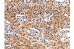 The image on the left is immunohistochemistry of paraffin-embedded Human lung cancer tissue using CSB-PA201757(AMY2A Antibody) at dilution 1/50, on the right is treated with fusion protein. (Original magnification: 