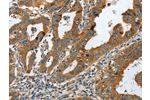 The image on the left is immunohistochemistry of paraffin-embedded Human gastic cancer tissue using CSB-PA201854(COL1A2 Antibody) at dilution 1/20, on the right is treated with fusion protein. (Original magnification: 