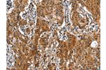 The image on the left is immunohistochemistry of paraffin-embedded Human gastic cancer tissue using CSB-PA203218(BGN Antibody) at dilution 1/50, on the right is treated with fusion protein. (Original magnification: 