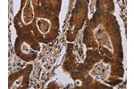 The image on the left is immunohistochemistry of paraffin-embedded Human colon cancer tissue using CSB-PA203330(DCAF6 Antibody) at dilution 1/50, on the right is treated with synthetic peptide. (Original magnification: 